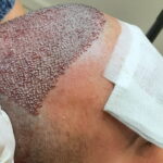 Your Step-by-Step Guide to FUE Hair Transplant London Treatment