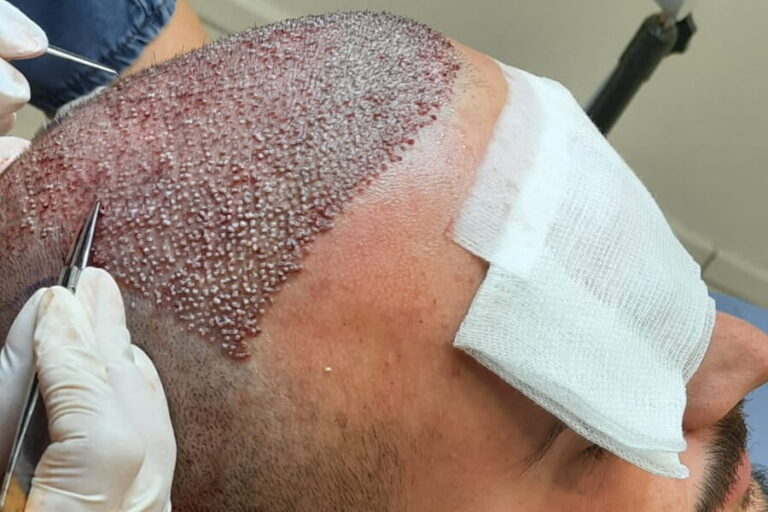 Your Step-by-Step Guide to FUE Hair Transplant London Treatment