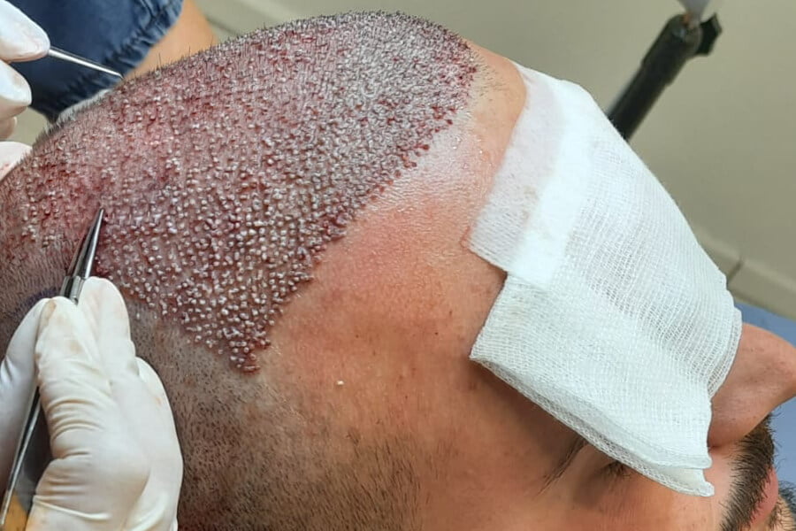 Your Step-by-Step Guide to FUE Hair Transplant London Treatment