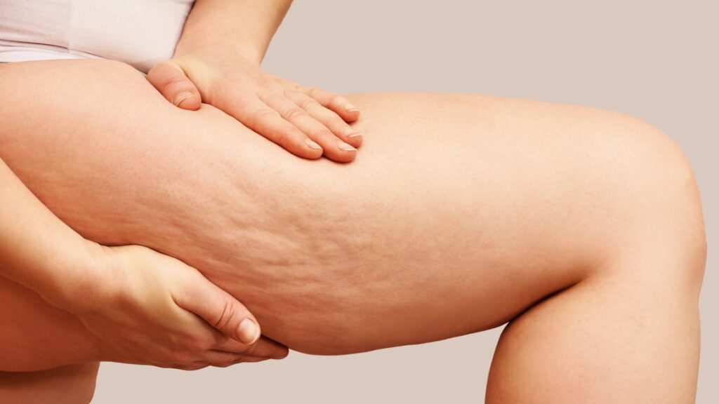 Dimpling Debunked: Why Only Deep Tissue Subcision Truly Erases Cellulite