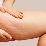 Dimpling Debunked: Why Only Deep Tissue Subcision Truly Erases Cellulite