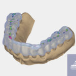 Improving Comfort and Accuracy with 3D Dental Lab Restorations