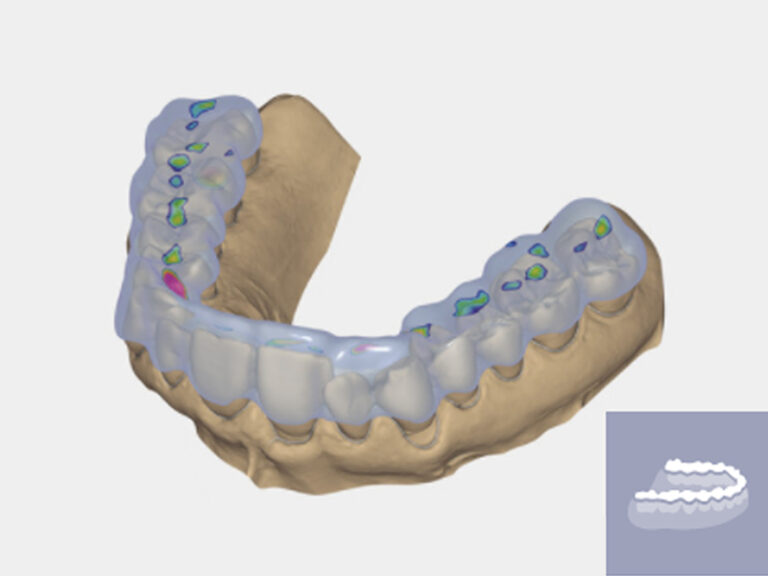 Improving Comfort and Accuracy with 3D Dental Lab Restorations